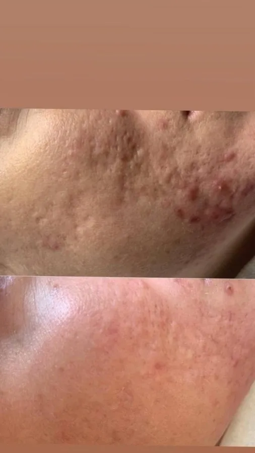 Acne treatment cheek before and after Irvine CA esthetician acne facial
