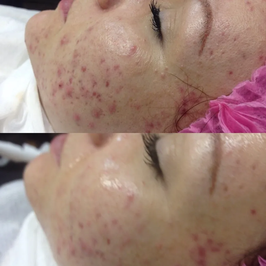 Acne facial treatment results multiple sessions Irvine CA