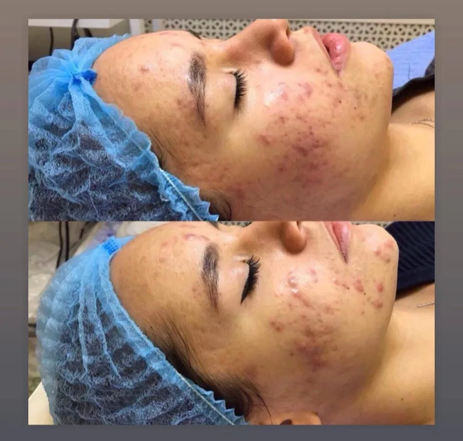 Acne facial cleanse treatment before and after Irvine CA skincare