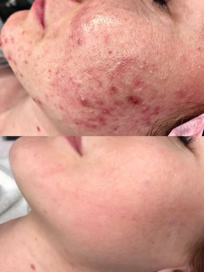 Acne treatment facial before and after Irvine CA