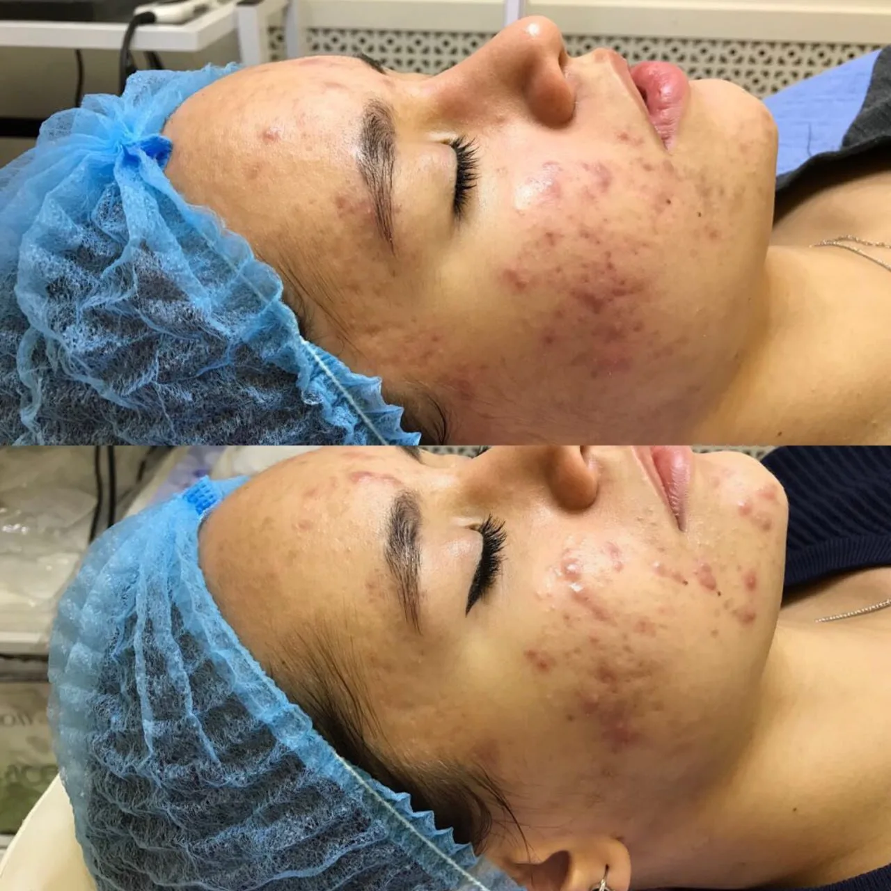 Acne treatment before and after Irvine CA