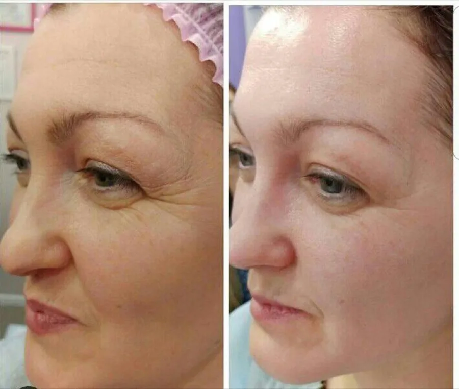 Anti-aging facial eye wrinkles before and after Irvine CA
