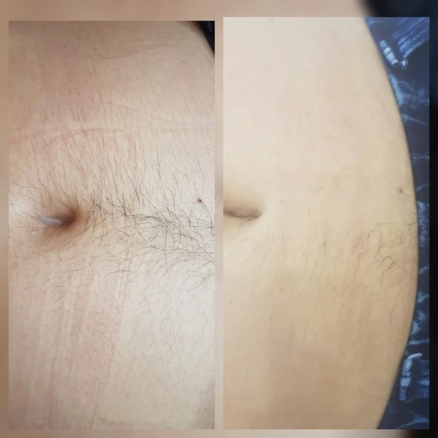 Abdomen belly hair permanent electrolysis removal before and after Irvine CA