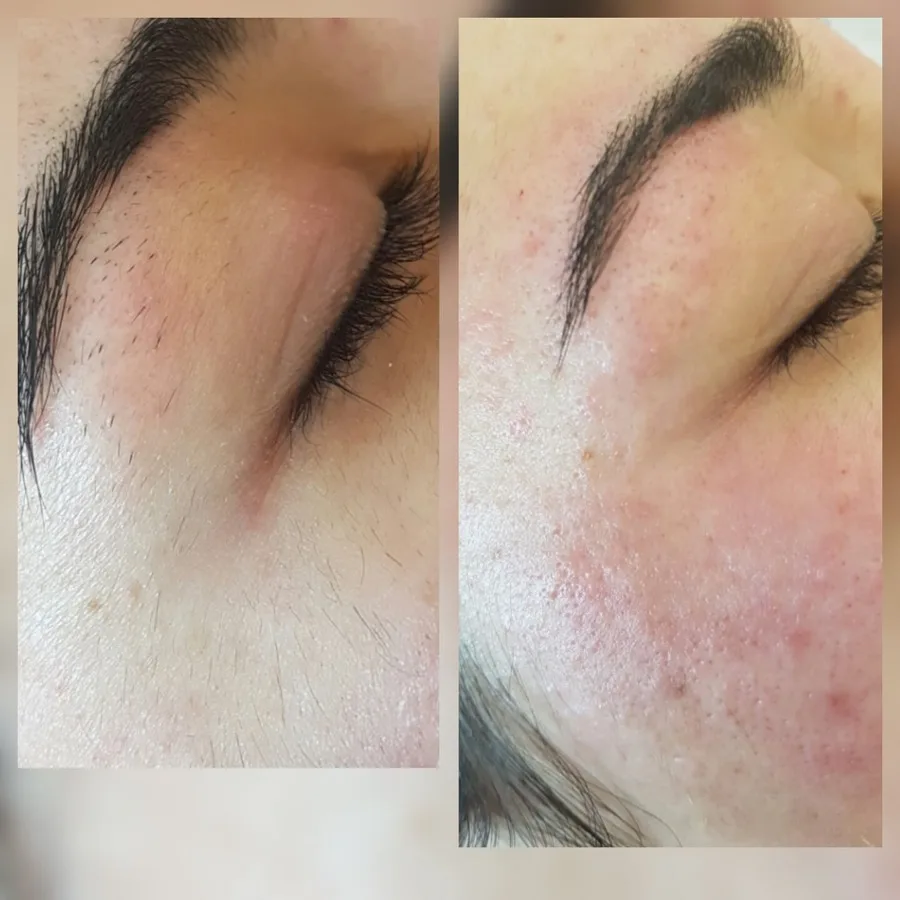 Electrolysis cheek facial hair removal before after Irvine CA