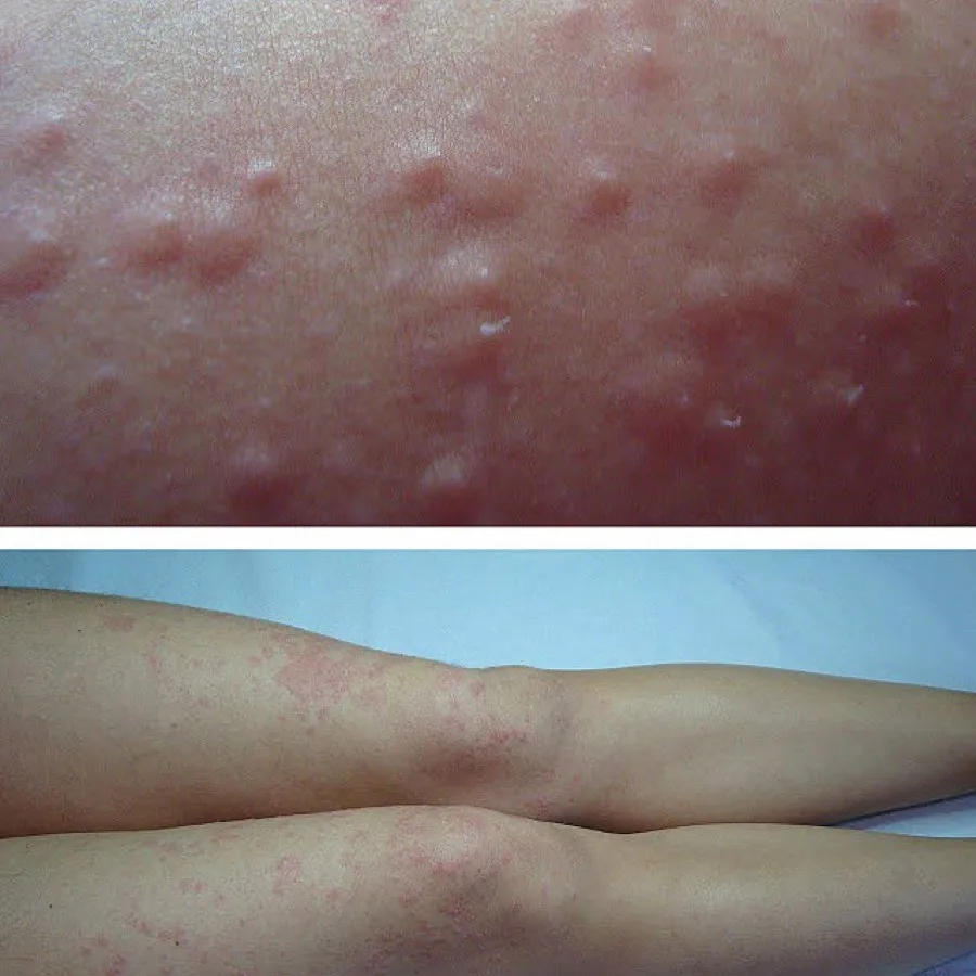 Leg ingrown hairs and bumps electrolysis permanent removal before and after Irvine CA
