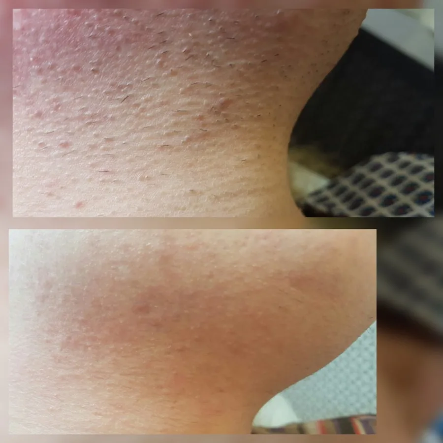 Electrolysis neck and chin before after Irvine CA