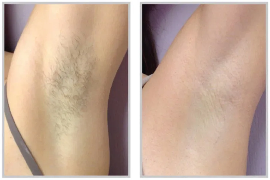 PCOS underarm electrolysis before and after Irvine CA
