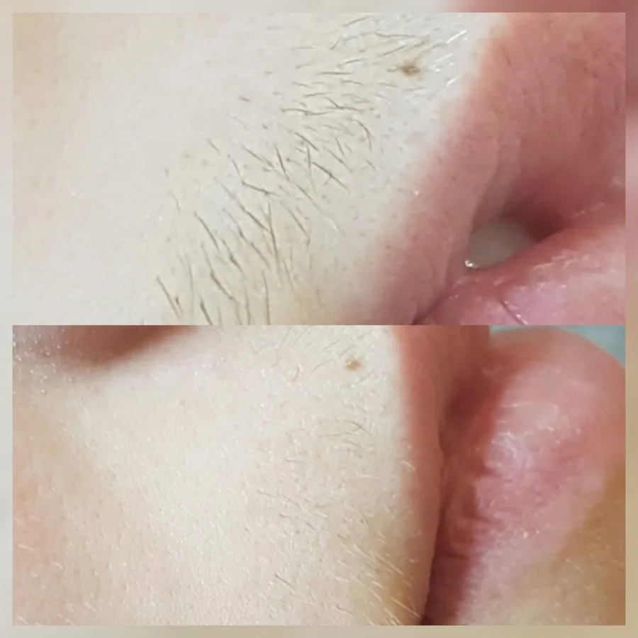 Upper lip electrolysis permanent removal before and after Irvine CA