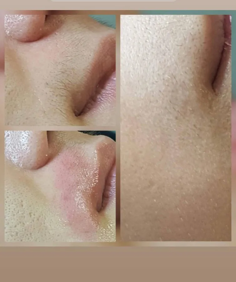 Facial electrolysis upper lip before and after Irvine CA