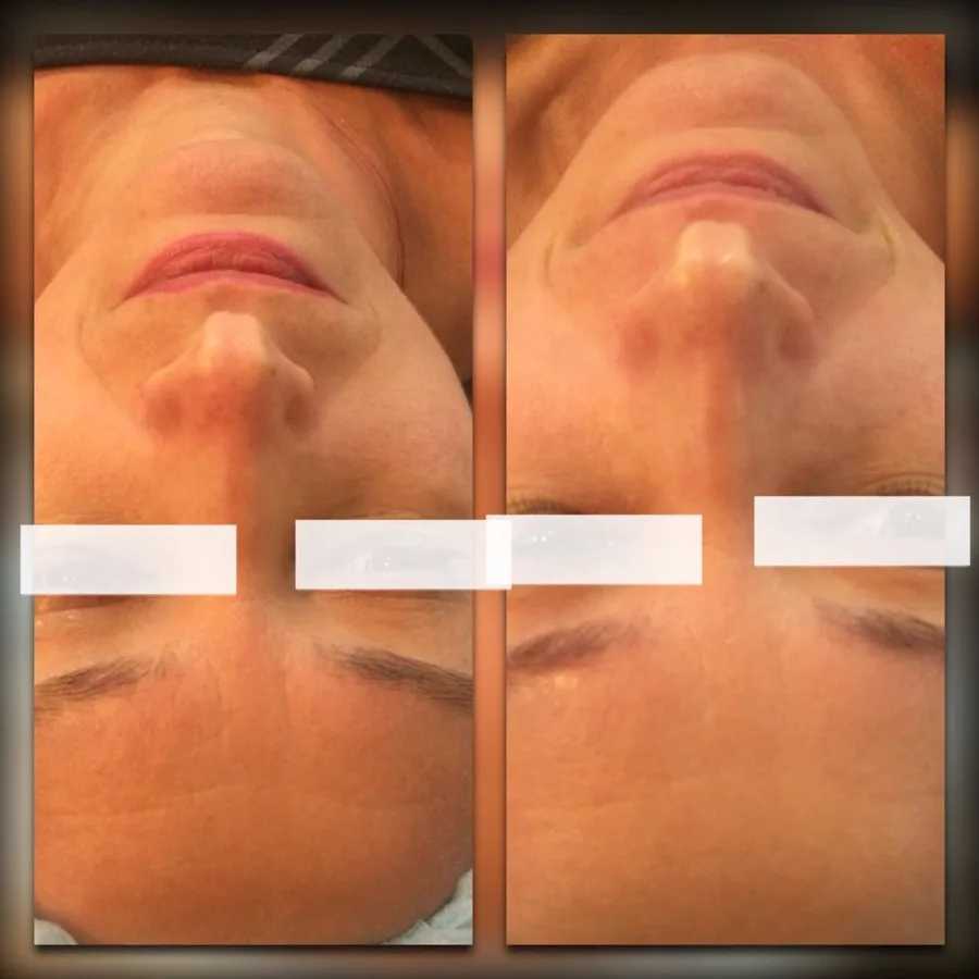Microcurrent face lift nasolabial folds before after Irvine CA