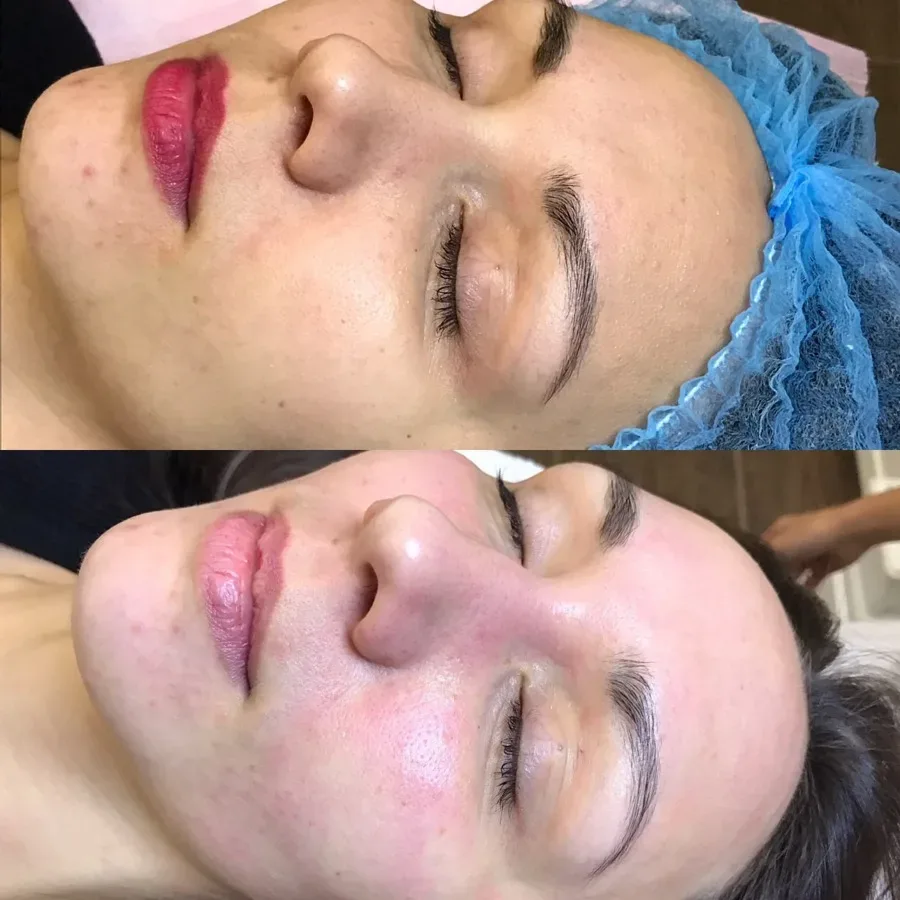 Facial skin care treatment HydraFacial deep cleanse result Irvine CA