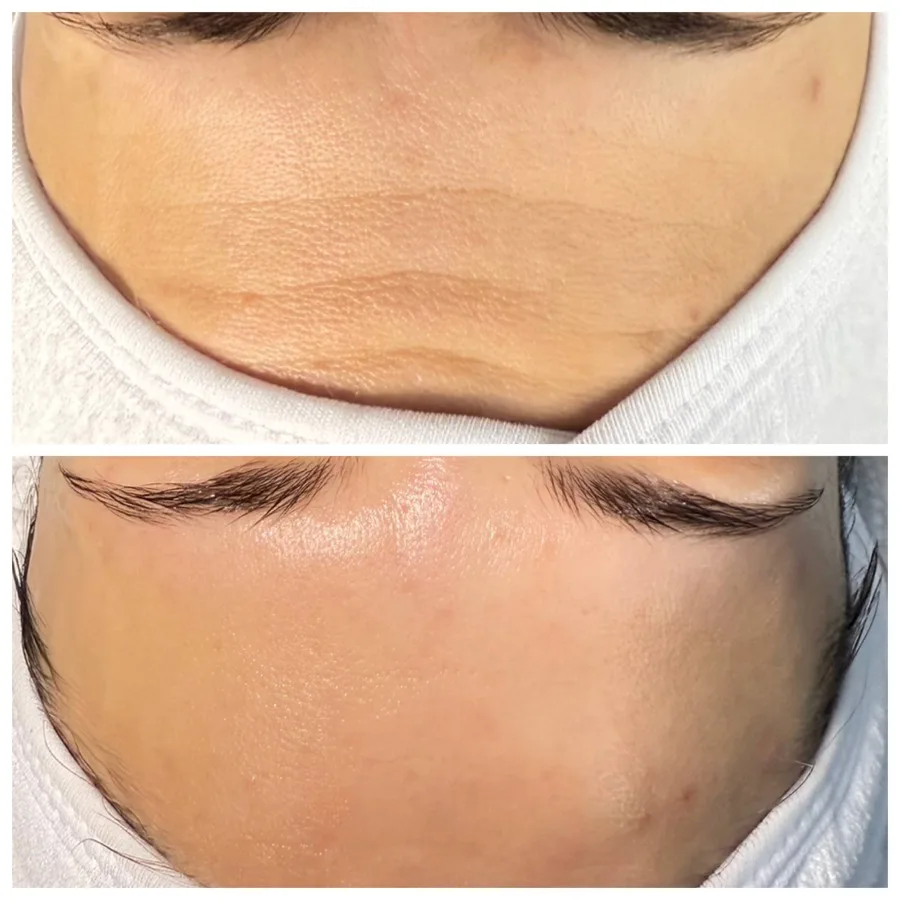 Facial massage sculpting lymphatic drainage results Irvine CA
