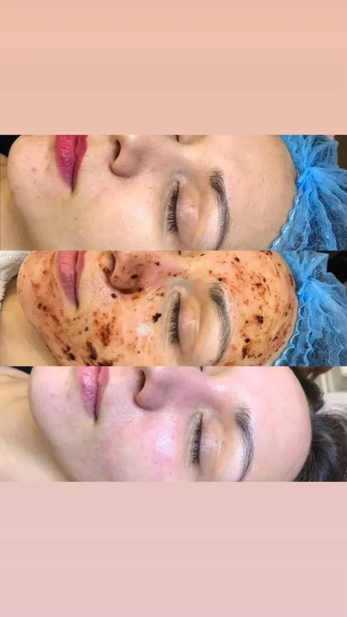 Chemical peel skin treatment before after result Irvine CA licensed cosmetologist