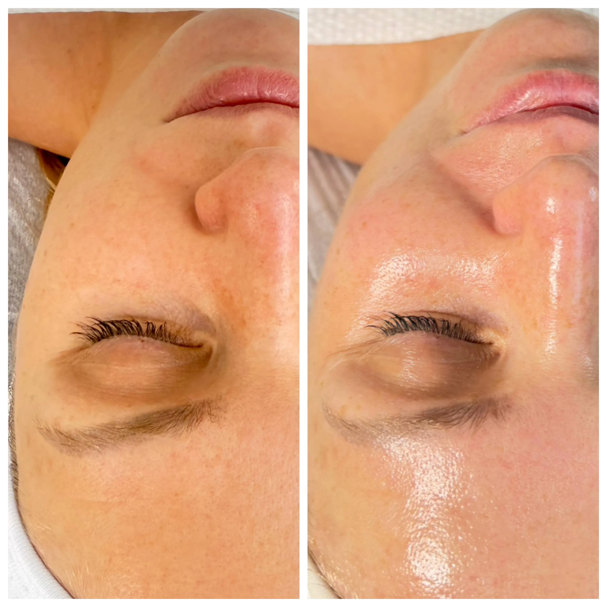 Chemical peel Irvine CA