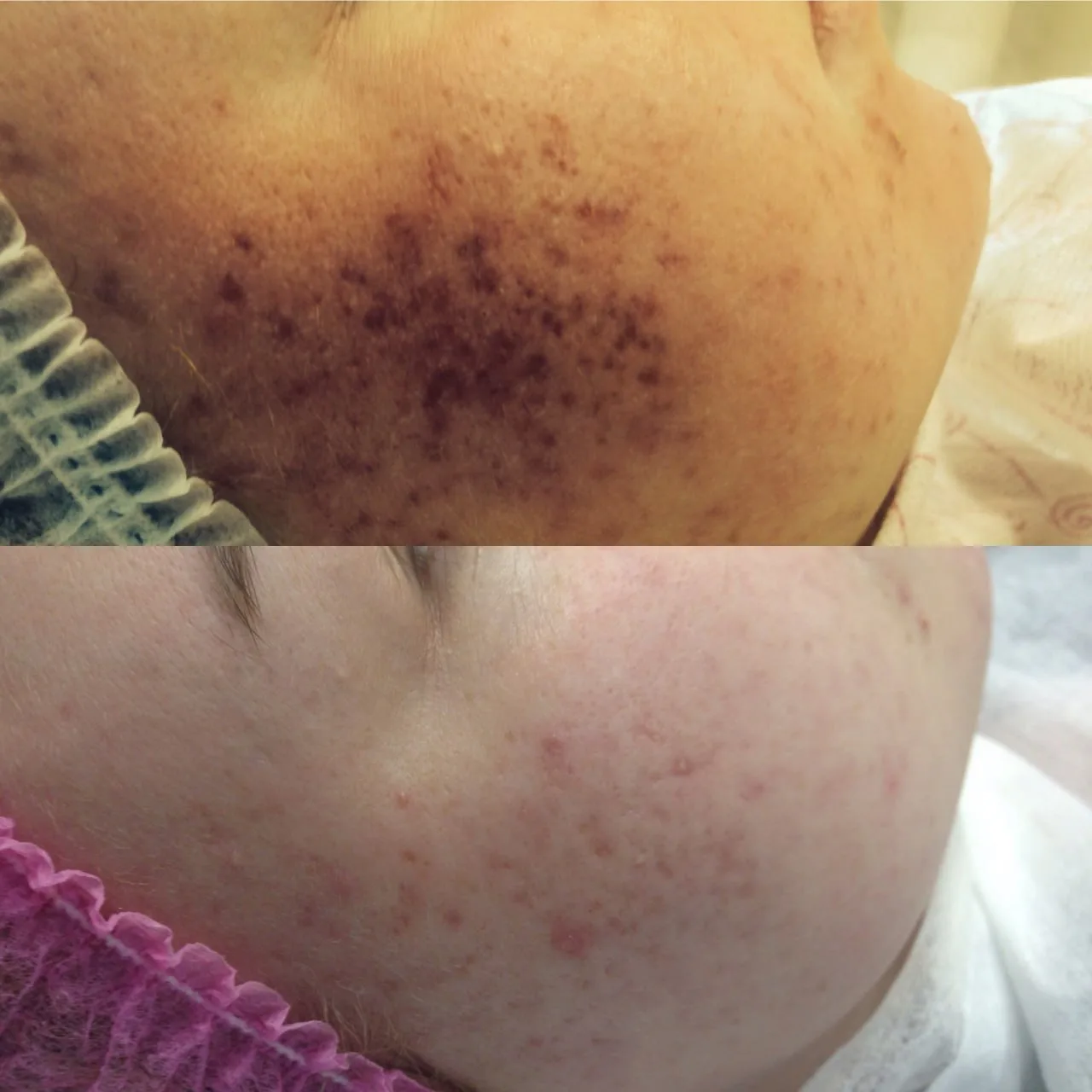 Pigmentation body treatment before and after Irvine CA