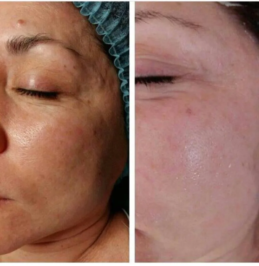 Face pigmentation dark spots treatment before and after Irvine CA licensed esthetician