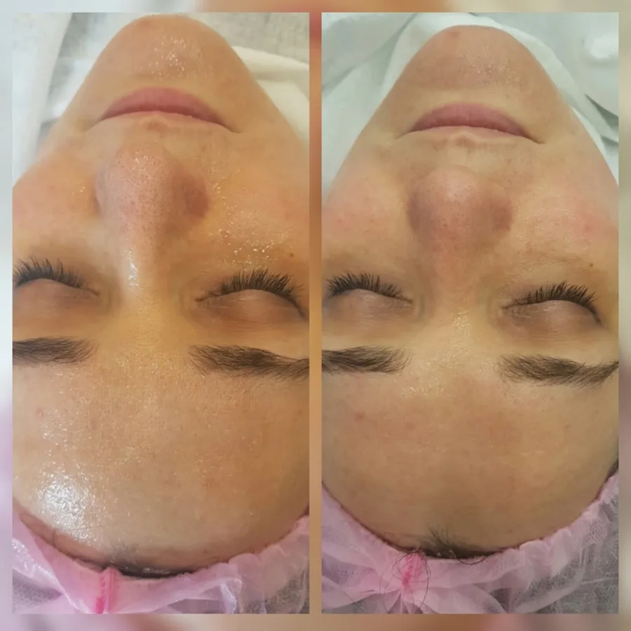 Pigmentation spot nose face before and after treatment Irvine CA esthetician