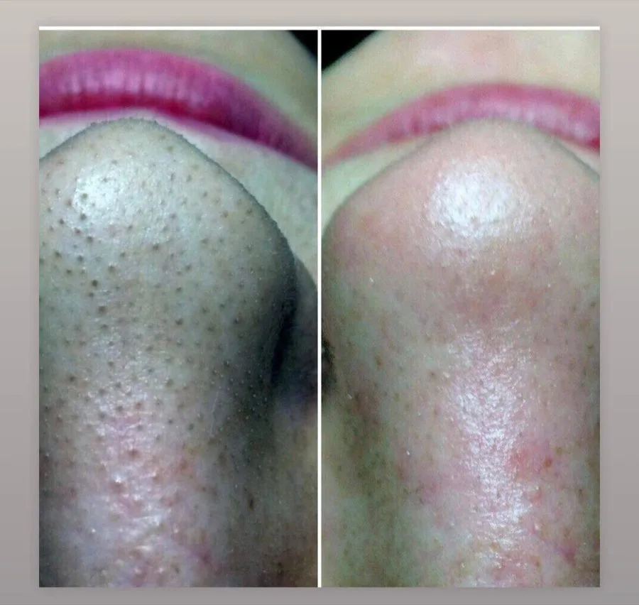 Enlarged pores blackheads nose before and after deep cleanse facial Irvine CA