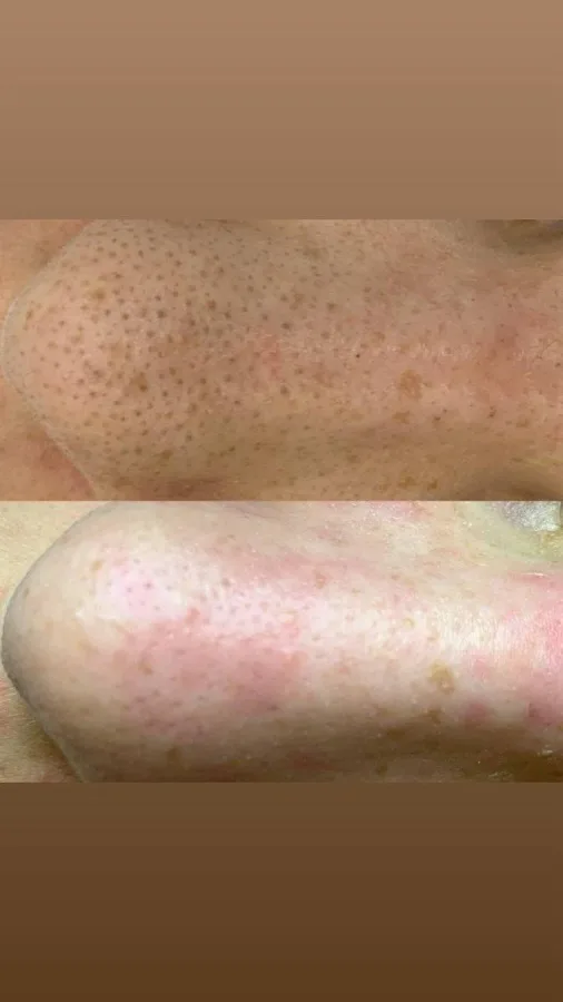 Clogged pores nose before and after professional facial cleansing Irvine CA