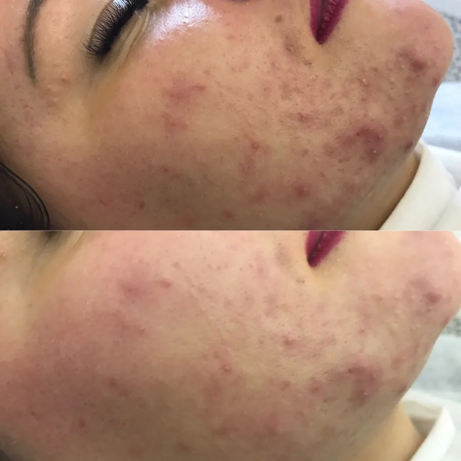 Post-acne dark spots hyperpigmentation treatment before and after Irvine CA