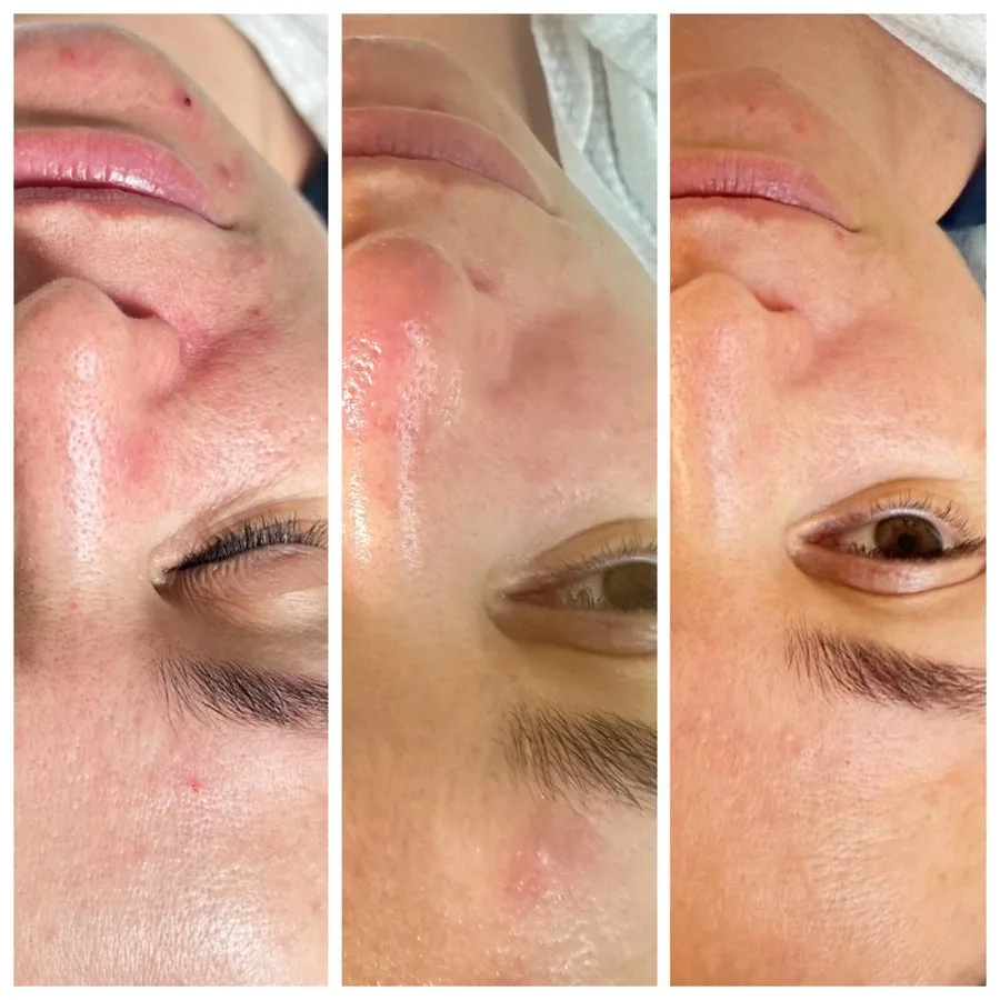 Rosacea redness treatment before and after Irvine CA