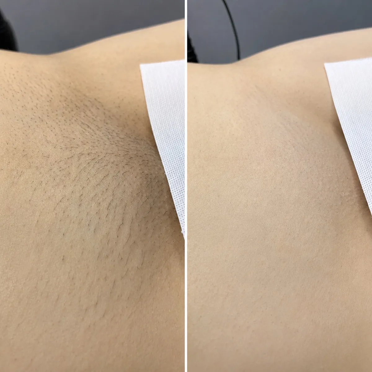 Bikini line waxing before and after results in Irvine California