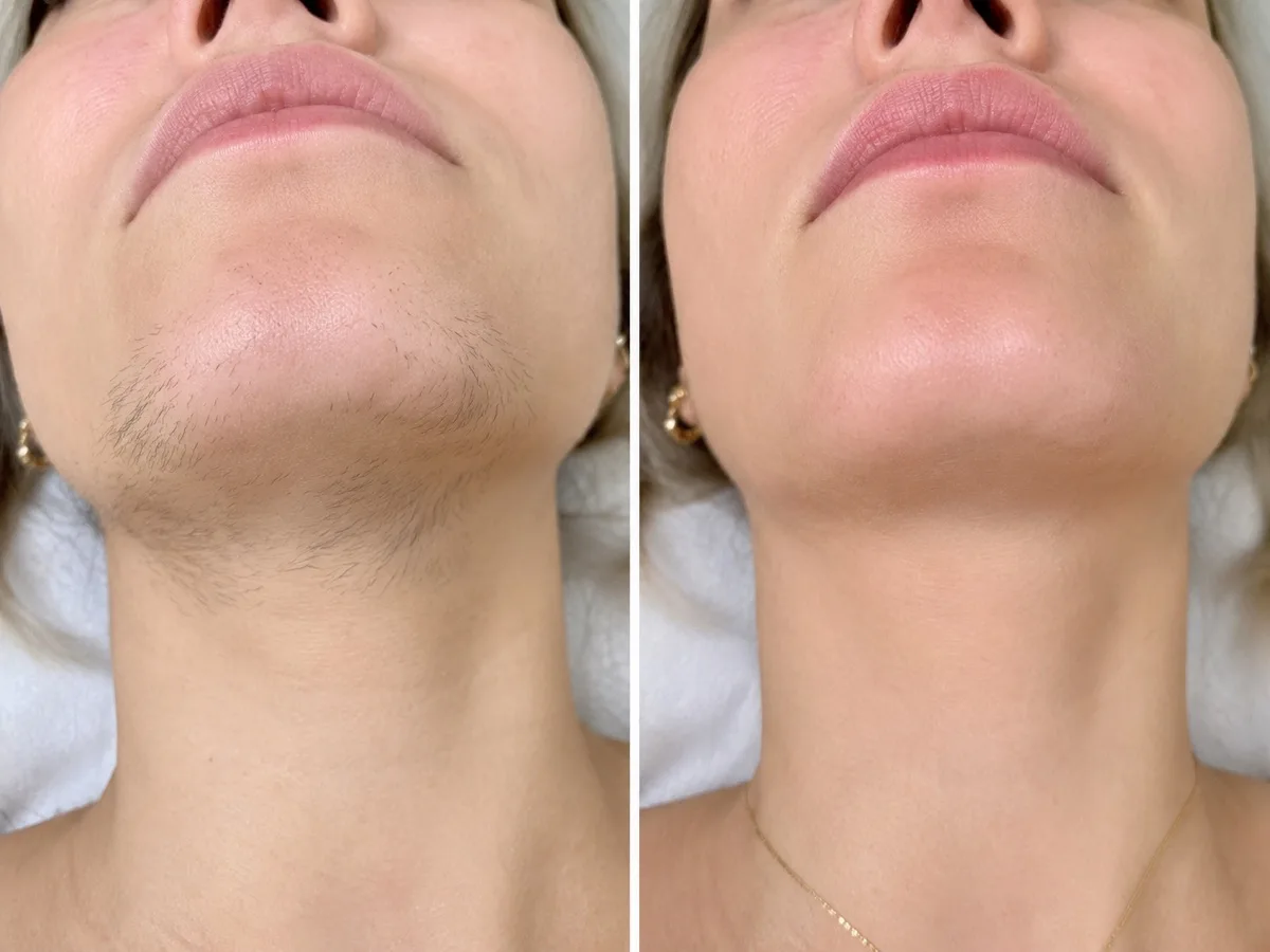 Chin waxing before and after results in Irvine California