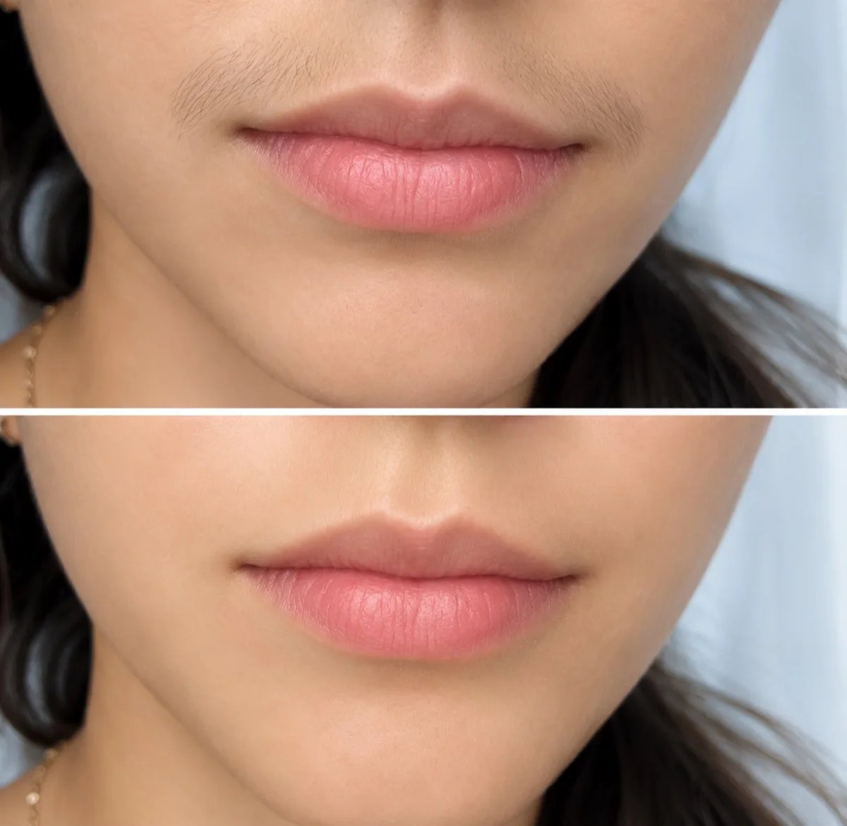 Upper lip waxing before and after results in Irvine California