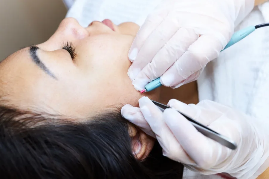 Electrolysis permanent hair removal procedure Irvine CA