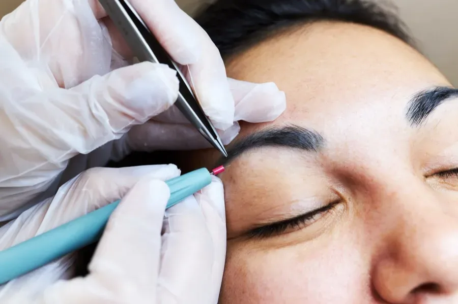 PCOS hair removal electrolysis specialist Orange County Irvine CA