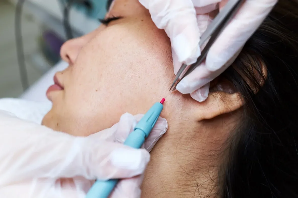 Electrolysis permanent hair removal procedure Irvine CA licensed esthetician